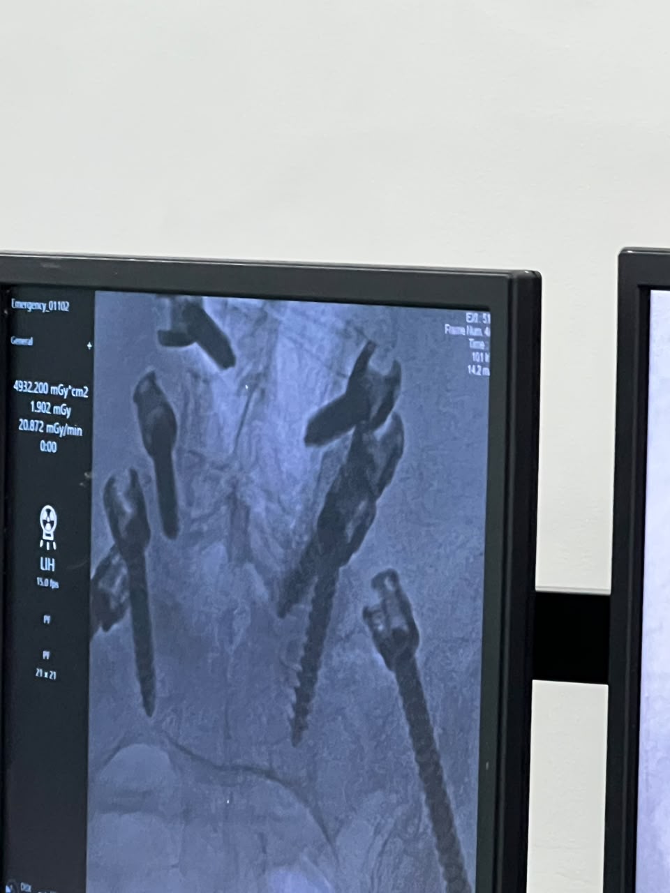 Registro del sistema TRACKER durante un procedimiento en quirófano