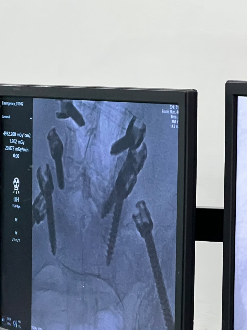 Registro del sistema TRACKER durante un procedimiento en quirófano