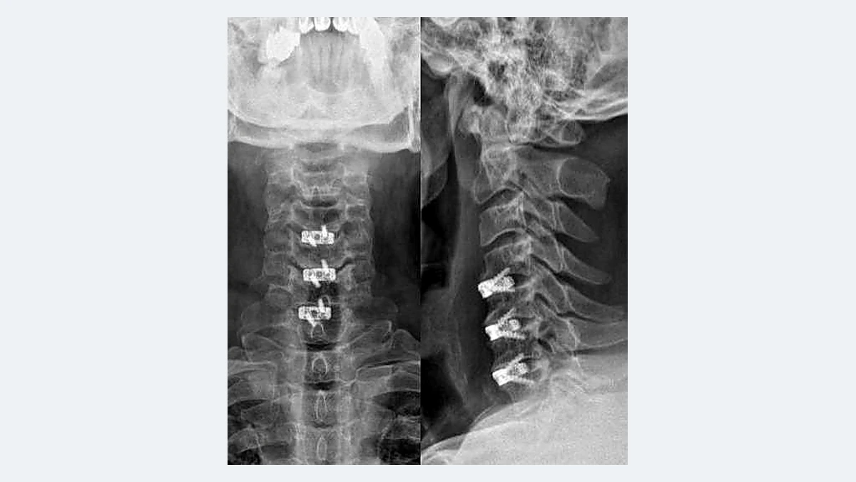 Enfermedades de la columna cervical