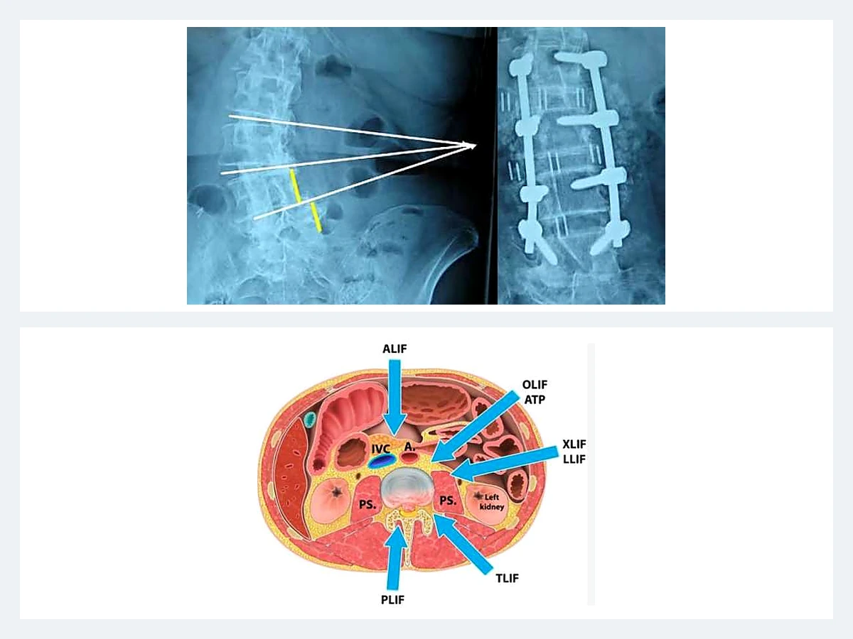 Abordajes quirúrgicos de columna lumbar