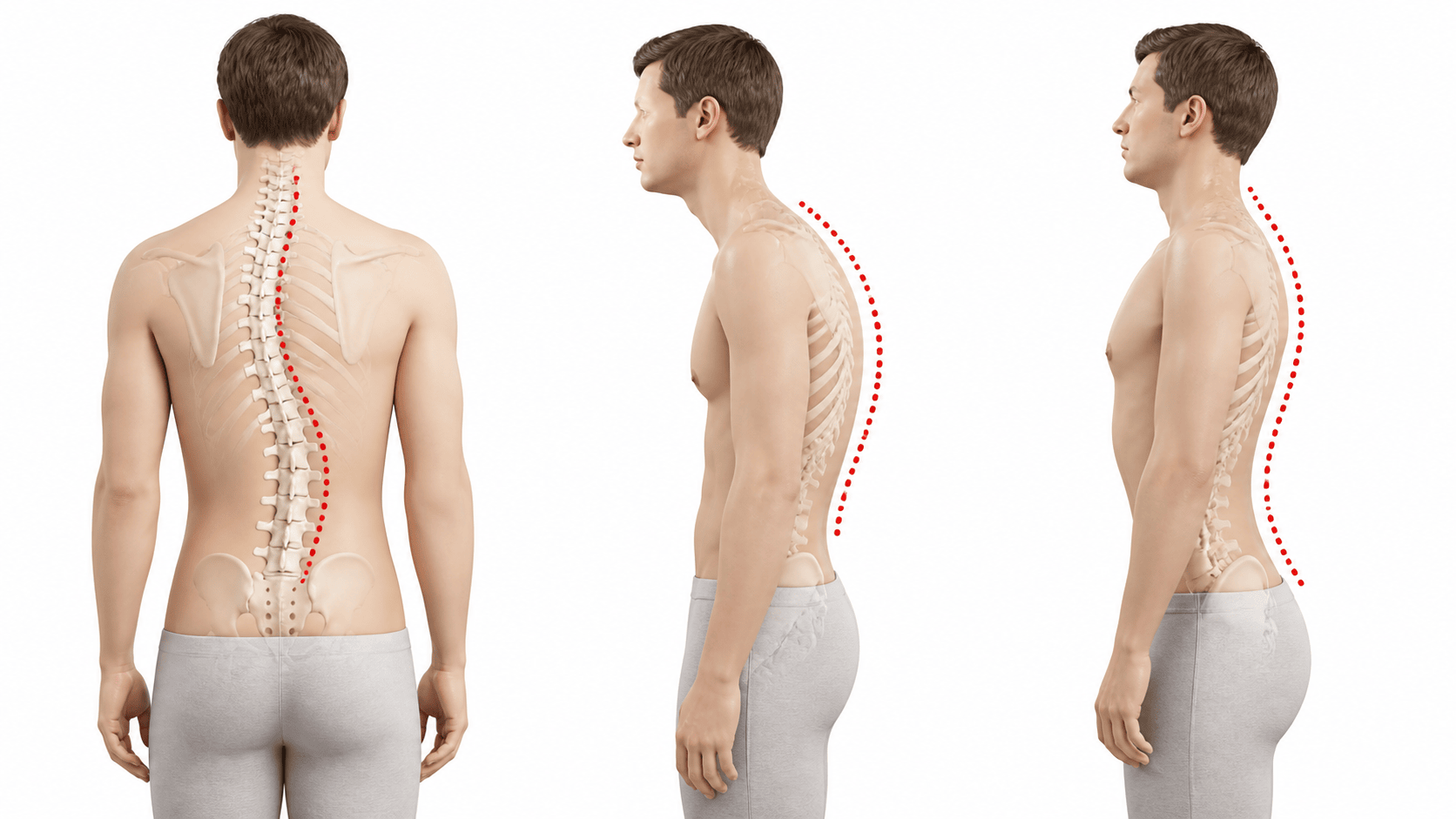 Imagen médica de deformidades de la columna